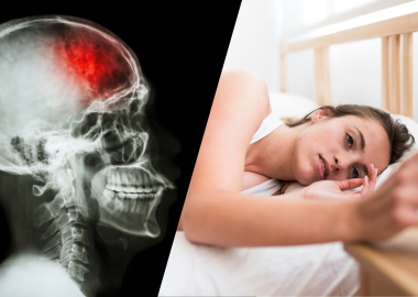 una persona con insomnio, más radiografia de una persona sufiriendo un ACV.
