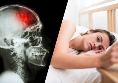 una persona con insomnio, más radiografia de una persona sufiriendo un ACV.